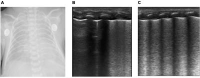 Case Report: Lung Ultrasound in Critically Ill Neonates With Lung Diseases: Experience From Several Typical Cases